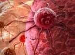 أبحاث جديدة تكافح السرطان بالليزر 